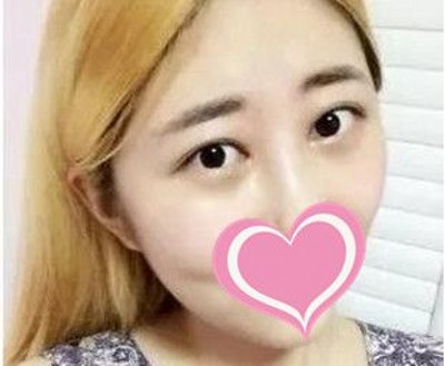 超声波去眼袋让时光驻足留住美!391 超声波去眼袋让时光驻足留住美!391