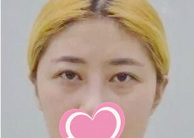 超声波去眼袋让时光驻足留住美!391 超声波去眼袋让时光驻足留住美!391