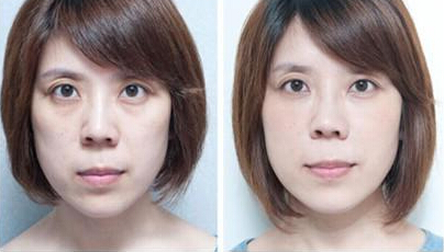 在重庆超雅去眼袋手术后让我笑起来更好看028 在重庆超雅去眼袋手术后让我笑起来更好看028