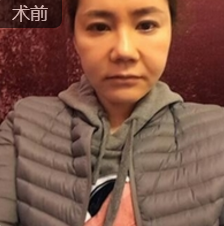 重庆超雅面部提升术让你50岁如同30岁!845 重庆超雅面部提升术让你50岁如同30岁!845