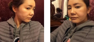 重庆超雅面部提升术让你50岁如同30岁!845 重庆超雅面部提升术让你50岁如同30岁!845