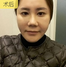 重庆超雅面部提升术让你50岁如同30岁!845 重庆超雅面部提升术让你50岁如同30岁!845