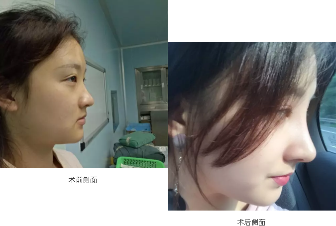 重庆超雅隆鼻手术让你圆梦成真!389 重庆超雅隆鼻手术让你圆梦成真!389