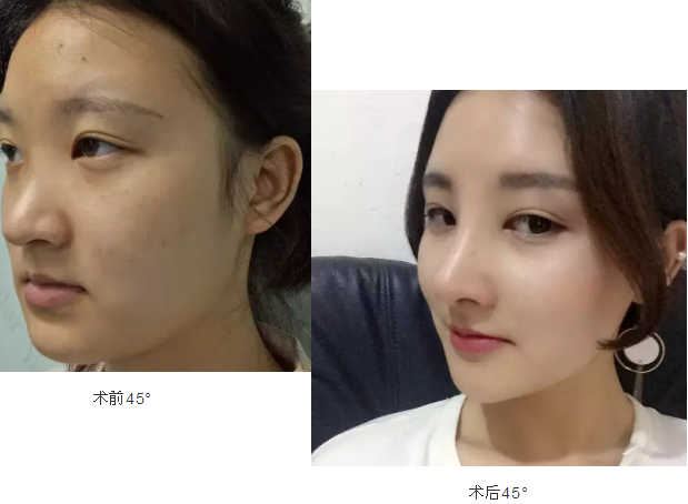 重庆超雅隆鼻手术让你圆梦成真!389 重庆超雅隆鼻手术让你圆梦成真!389
