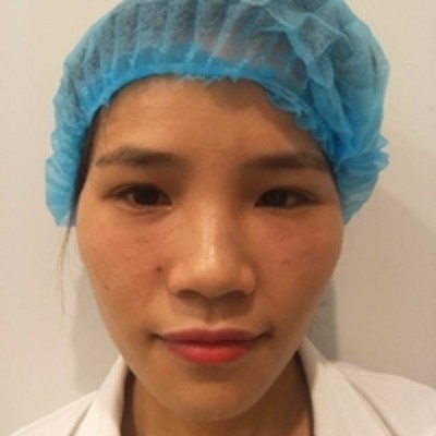 ー个程序员超 声 波去眼袋成功得去眼袋亲历! ー个程序员超 声 波去眼袋成功得去眼袋亲历!