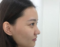 娘胎自带的高鼻梁也是做隆鼻手术，去哪里？重庆超雅！！686
