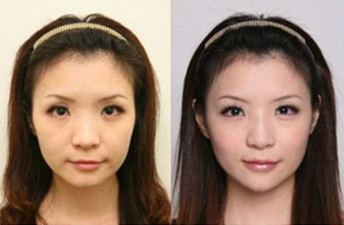 娘胎自带的高鼻梁也是做隆鼻手术，去哪里？重庆超雅！！686