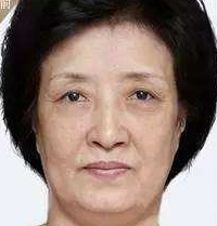 超雅整形医院的面部提升术帮我消除了木偶纹263 超雅整形医院的面部提升术帮我消除了木偶纹263