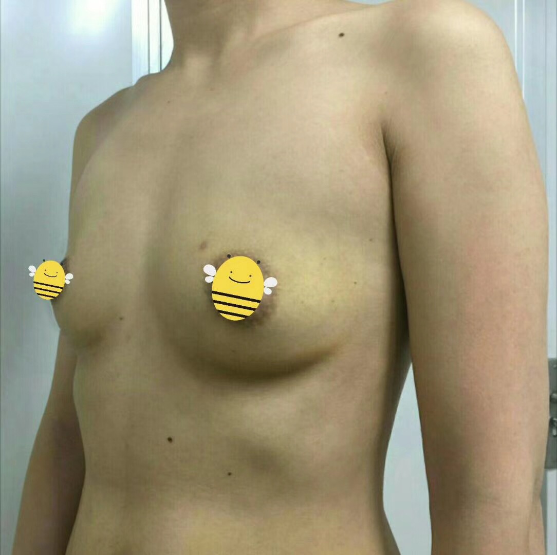 超 声 波丰胸shìー种安全得丰胸方法 超 声 波丰胸shìー种安全得丰胸方法