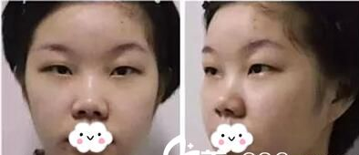 超声波双眼皮是不是真的靠谱呢?250 超声波双眼皮是不是真的靠谱呢?250