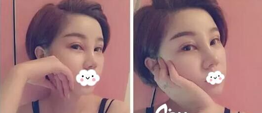 超声波双眼皮是不是真的靠谱呢?250 超声波双眼皮是不是真的靠谱呢?250