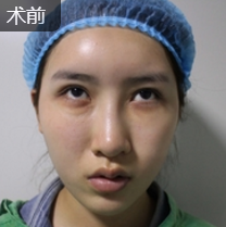 去眼袋哪招最好?重庆超雅去眼袋手术!583 去眼袋哪招最好?重庆超雅去眼袋手术!583