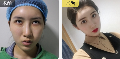 去眼袋哪招最好?重庆超雅去眼袋手术!583 去眼袋哪招最好?重庆超雅去眼袋手术!583