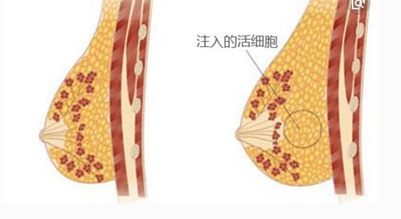 超 声 波自体脂肪丰胸让wǒ摆脱胸垫le! 超 声 波自体脂肪丰胸让wǒ摆脱胸垫le!