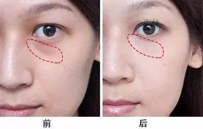 超雅整形医院的去眼袋手术让我轻松去眼袋038 超雅整形医院的去眼袋手术让我轻松去眼袋038