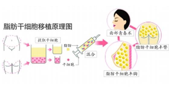 超 声 波自体脂肪填充术很棒，都能起到面部提升术作用