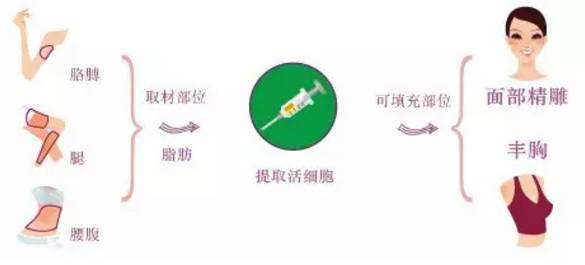 超 声 波自体脂肪填充术很棒，都能起到面部提升术作用