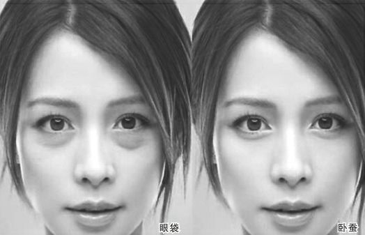 眼袋怎么解决?来重庆超雅解决100 眼袋怎么解决?来重庆超雅解决100