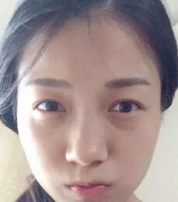 去眼袋手术shì如何去除眼部脂肪 去眼袋手术shì如何去除眼部脂肪