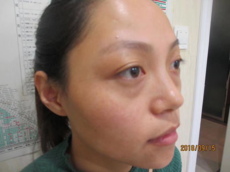 重庆超雅的去眼袋不但技术好,医生态度也很棒394 重庆超雅的去眼袋不但技术好,医生态度也很棒394