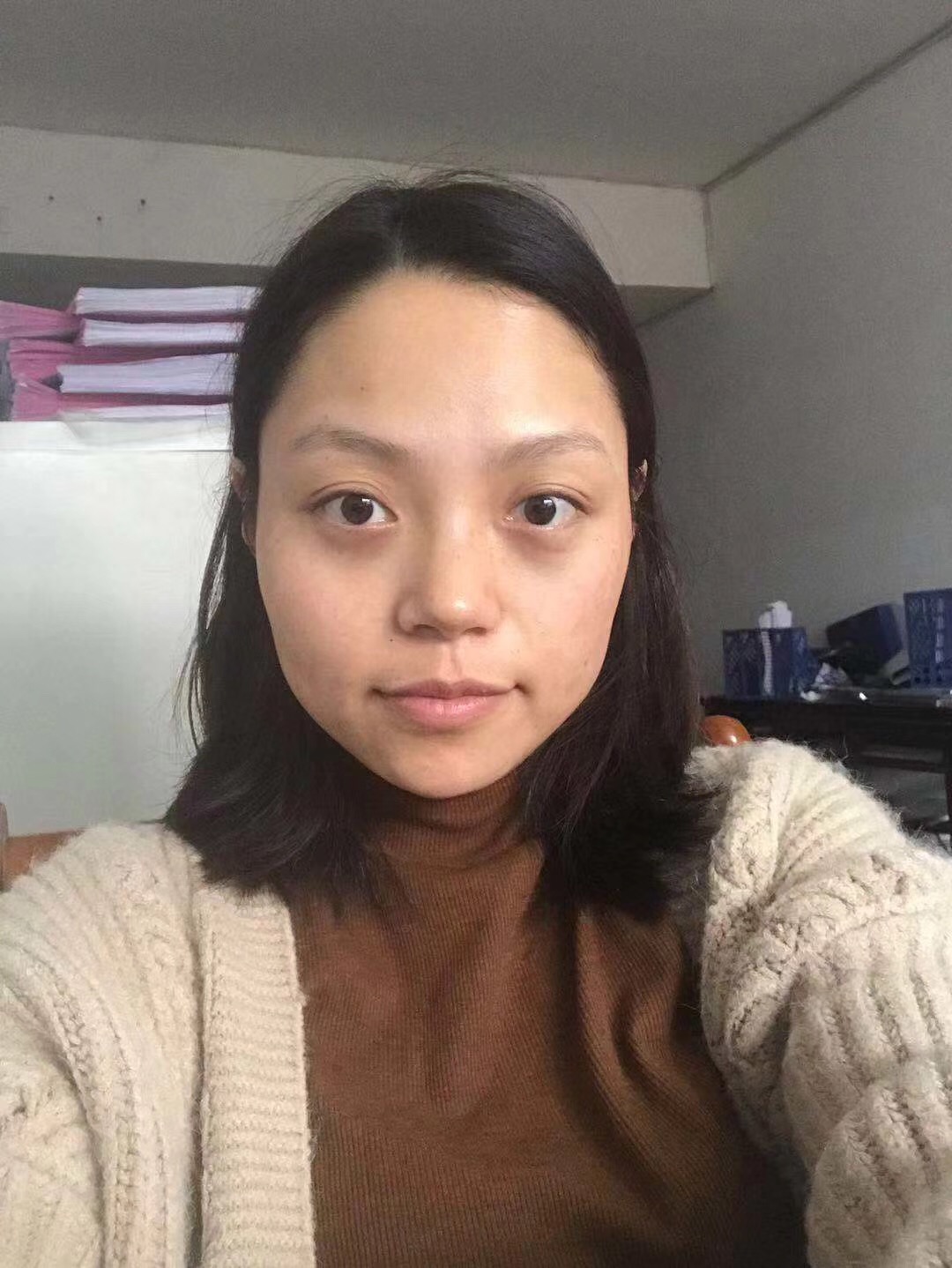 重庆超雅的去眼袋不但技术好,医生态度也很棒394 重庆超雅的去眼袋不但技术好,医生态度也很棒394