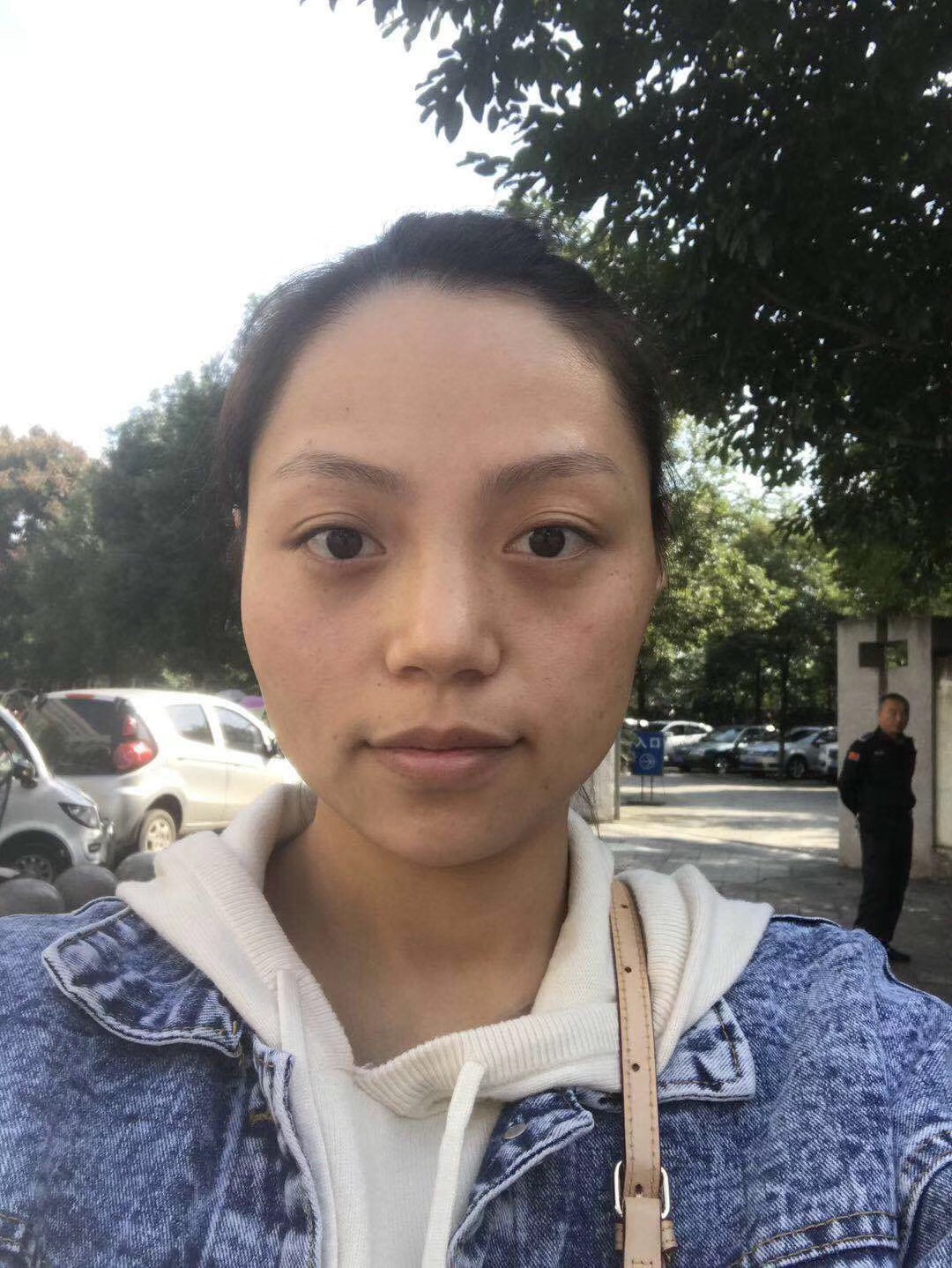 重庆超雅的去眼袋不但技术好,医生态度也很棒394 重庆超雅的去眼袋不但技术好,医生态度也很棒394