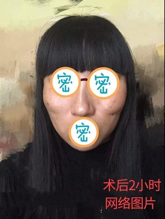 面部提升术