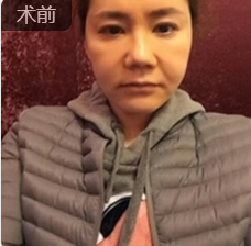面部提升术