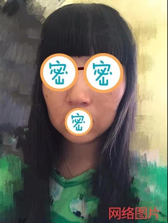 面部提升术