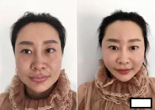 带着妈妈去做超声波去眼袋,去眼袋670 带着妈妈去做超声波去眼袋,去眼袋670