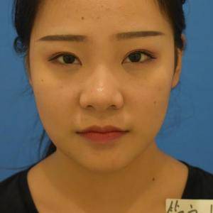 自然的鼻子才会更美丽,超雅不开刀隆鼻手术337 自然的鼻子才会更美丽,超雅不开刀隆鼻手术337