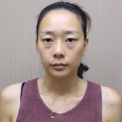 效果很棒的去眼袋手术,超声波去眼袋766 效果很棒的去眼袋手术,超声波去眼袋766