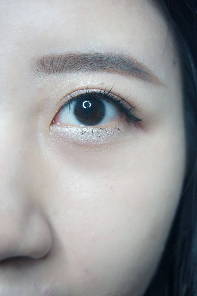 如何永别眼袋这个问题呢?优选超声波去眼袋301 如何永别眼袋这个问题呢?优选超声波去眼袋301