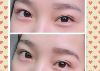 如何永别眼袋这个问题呢?优选超声波去眼袋301 如何永别眼袋这个问题呢?优选超声波去眼袋301