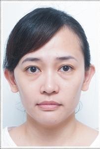去眼袋的常见问题,解决方案583 去眼袋的常见问题,解决方案583