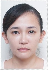 去眼袋的常见问题,解决方案583 去眼袋的常见问题,解决方案583