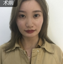 重庆超雅面部提升术让“衰老”变“年轻”! 重庆超雅面部提升术让“衰老”变“年轻”!