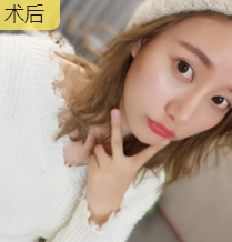 重庆超雅面部提升术让“衰老”变“年轻”! 重庆超雅面部提升术让“衰老”变“年轻”!