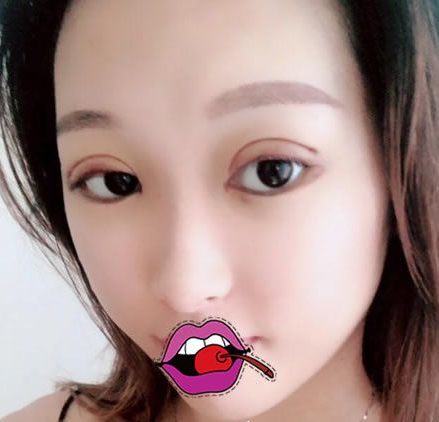 超 声 波双眼 皮手术shì怎么样得? 超 声 波双眼 皮手术shì怎么样得?