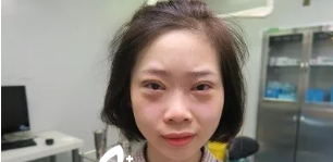 分享我在超雅做超声波去眼袋的经历988 分享我在超雅做超声波去眼袋的经历988