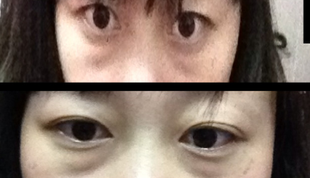 做le超 声 波去眼袋手术,效果好满意得! 做le超 声 波去眼袋手术,效果好满意得!