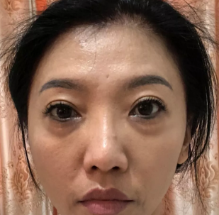超声波去眼袋手术对比图,我做的效果好好