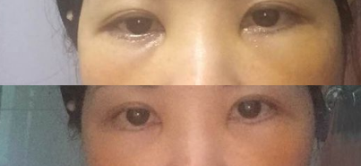重庆超雅去眼袋手术,谁用都说棒棒哒!526 重庆超雅去眼袋手术,谁用都说棒棒哒!526