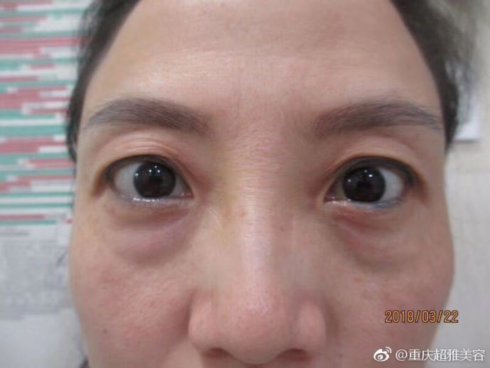 重庆超雅的超声波去眼袋让我非常满意293 重庆超雅的超声波去眼袋让我非常满意293