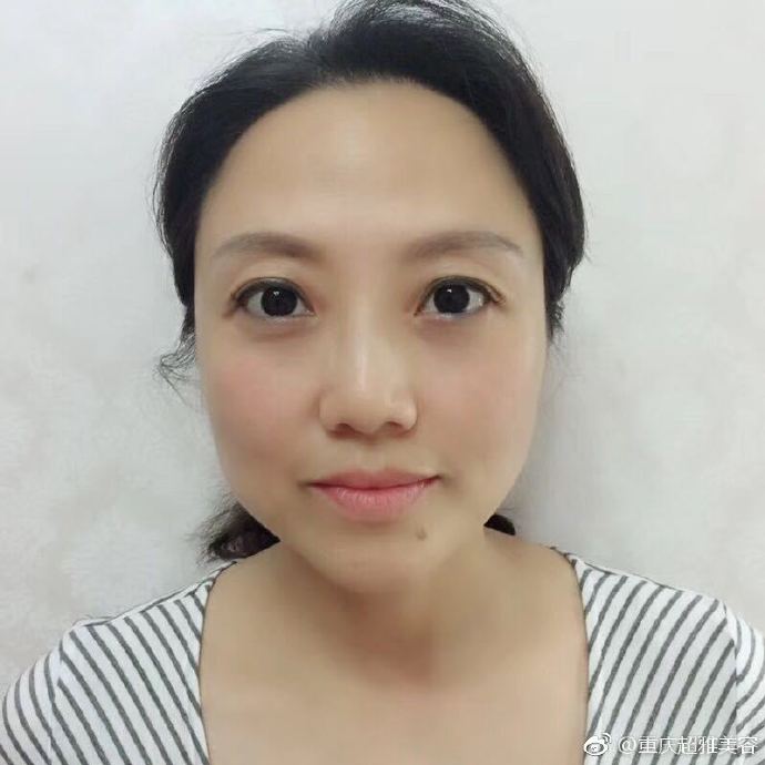重庆超雅的超声波去眼袋让我非常满意293 重庆超雅的超声波去眼袋让我非常满意293