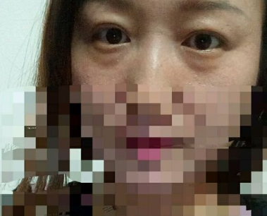 重庆超雅去眼袋手术，让眼睛干干净净得