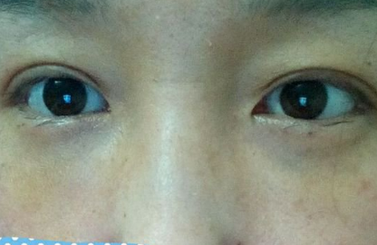 重庆超雅去眼袋手术，让眼睛干干净净得