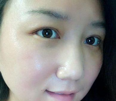 重庆超雅去眼袋手术，让眼睛干干净净得