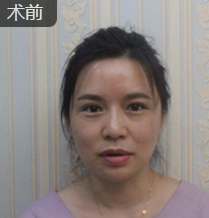 重庆超雅去眼袋手术,安全又省钱902 重庆超雅去眼袋手术,安全又省钱902