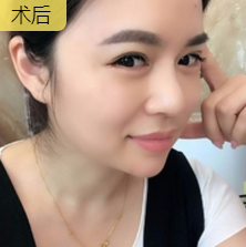 重庆超雅去眼袋手术,安全又省钱902 重庆超雅去眼袋手术,安全又省钱902